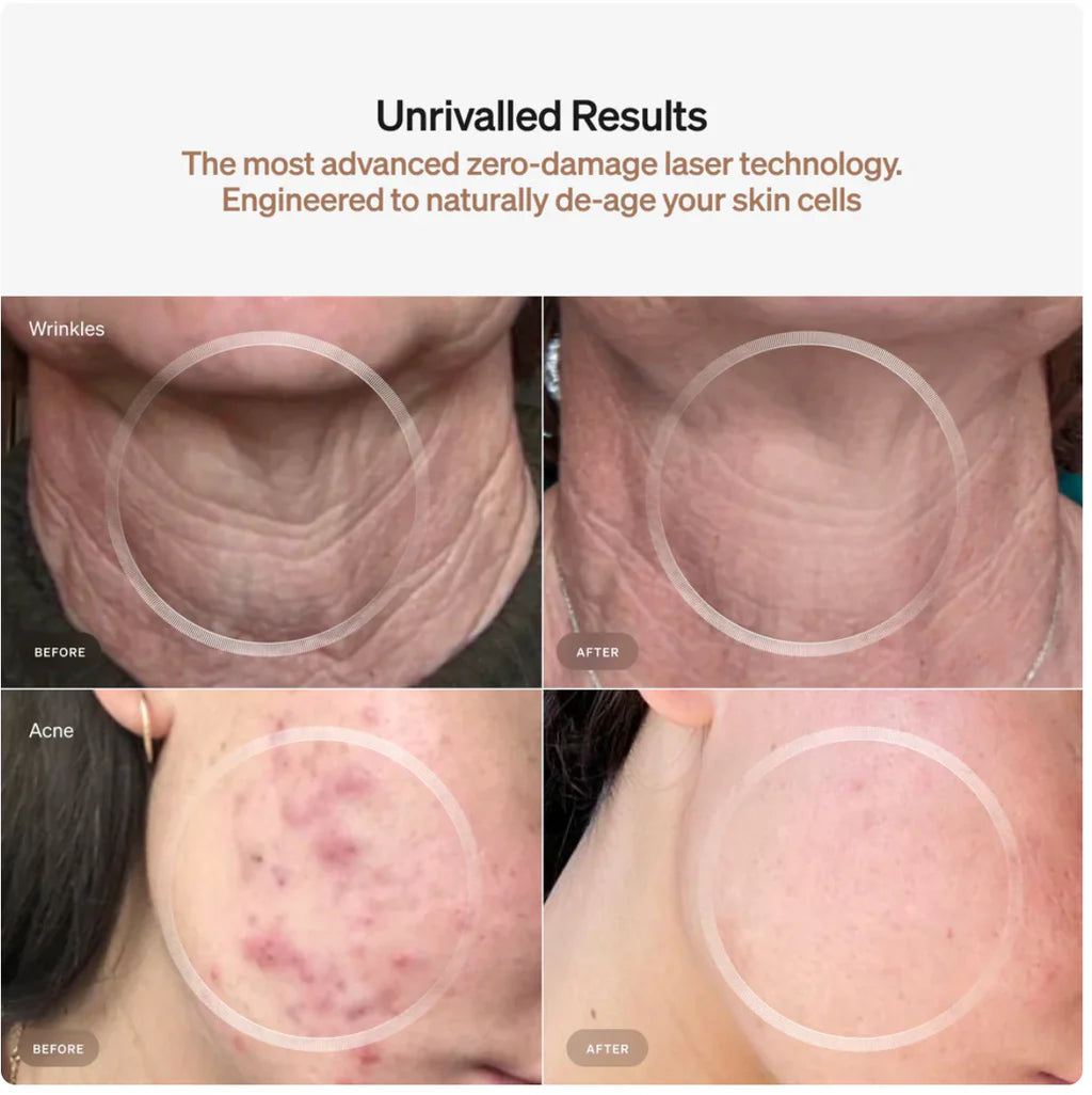 LYMA Laser